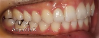 上顎右側側切歯失活歯 / 下顎側切歯１本欠損による上顎歯列の叢生