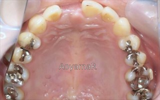 上顎右側中切歯先天欠如による前歯部の空隙歯列