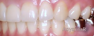 上顎右側中切歯先天欠如による前歯部の空隙歯列