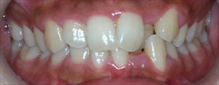 下顎歯列近心位、下顎前歯１本欠損による上下顎歯列の不調和