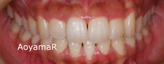 下顎歯列近心位、下顎前歯１本欠損による上下顎歯列の不調和