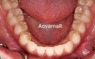 下顎歯列近心位、下顎前歯１本欠損による上下顎歯列の不調和