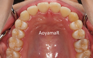 下顎右側第二小臼歯先天性欠如 / 上顎歯列の重度叢生