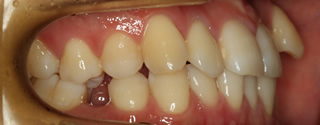 下顎右側第二小臼歯先天性欠如 / 上顎歯列の重度叢生