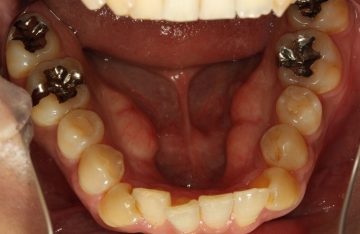 側切歯の舌側転位