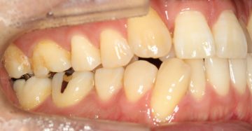 側切歯の舌側転位