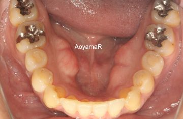 側切歯の舌側転位