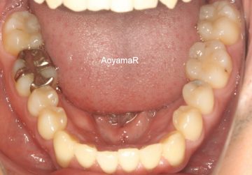 重度の歯肉退縮を伴う叢生