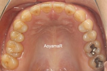 前歯にスペースがあるケース