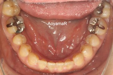 前歯にスペースがあるケース