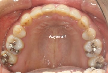 上顎両側犬歯低位唇側転位