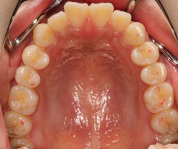 前歯部のオープンバイト