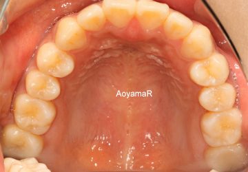 前歯部のオープンバイト