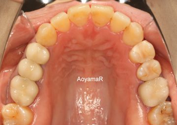 上下歯列の狭窄による開咬