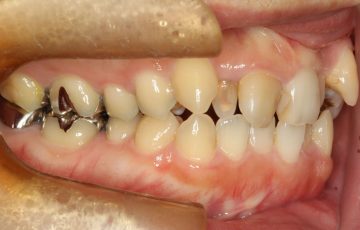 上顎両側側切歯が矮小歯による空隙歯列