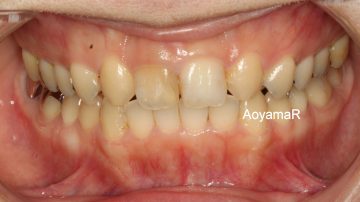 上顎両側側切歯が矮小歯による空隙歯列