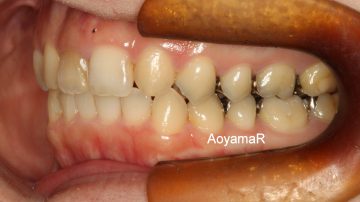 上顎両側側切歯が矮小歯による空隙歯列