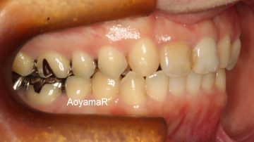 上顎両側側切歯が矮小歯による空隙歯列