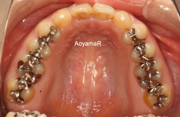 上顎両側側切歯が矮小歯による空隙歯列