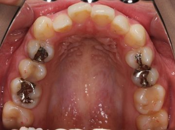 上顎歯列狭窄による開口