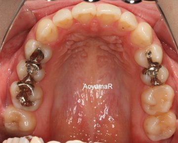 上顎歯列狭窄による開口