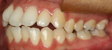 下顎側切歯先天性欠如を伴う上下顎前突