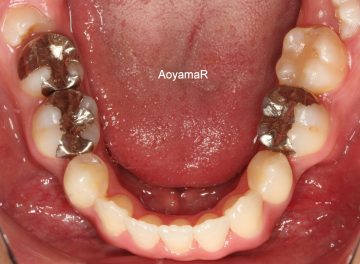 下顎側切歯先天性欠如を伴う上下顎前突