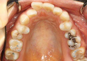 小臼歯片側抜歯による改善