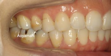 小臼歯片側抜歯による改善
