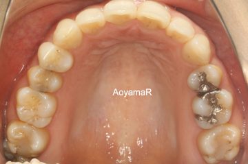 小臼歯片側抜歯による改善