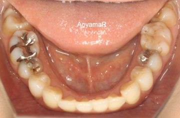 小臼歯片側抜歯による改善