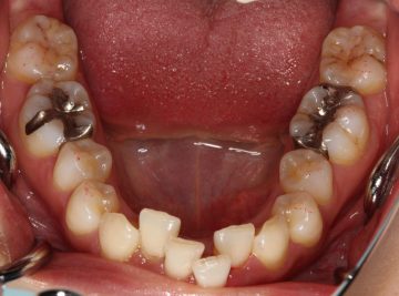 下顎前歯の叢生を伴うディープバイト