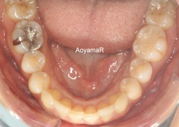 下顎前歯の叢生を伴うディープバイト