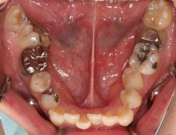 下顎左側大臼歯を抜歯したケース