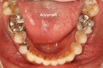 下顎左側大臼歯を抜歯したケース