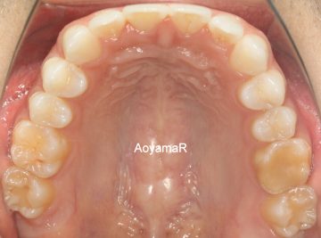 上顎前歯捻転歯の治療
