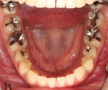 前歯部に空隙があり、咬み合わせが深いケース