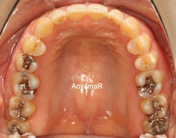 前歯部に空隙があり、咬み合わせが深いケース
