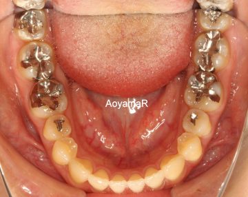 前歯部に空隙があり、咬み合わせが深いケース