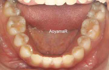 下顎前歯2本の先天欠如