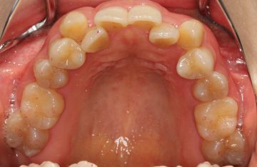 重度の叢生を非抜歯で治したケース