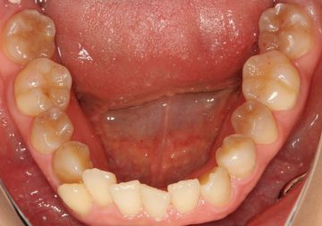重度の叢生を非抜歯で治したケース