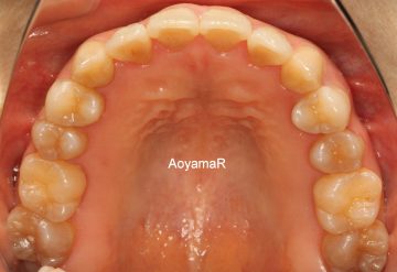 重度の叢生を非抜歯で治したケース