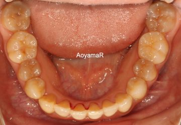重度の叢生を非抜歯で治したケース