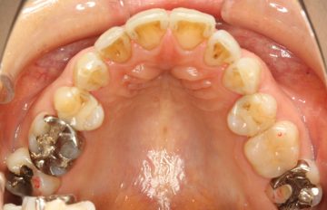 ワイヤーによる抜歯治療の後戻り治療