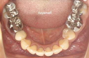 ワイヤーによる抜歯治療の後戻り治療