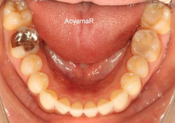 重度のガタガタを抜歯しないで改善