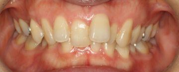 下顎側切歯2本先欠によるディープバイト