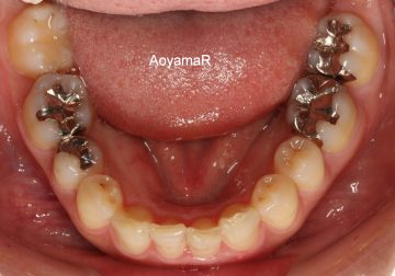 下顎側切歯2本先欠によるディープバイト