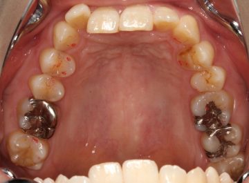 重度のⅡ級ディープバイト治療